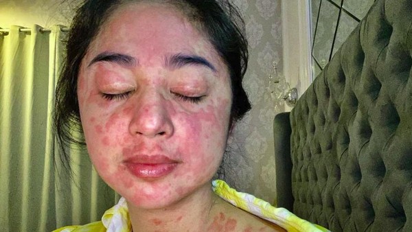 Terpapar COVID-19, Dewi Perssik Alami Ruam di Wajah dan Tubuhnya