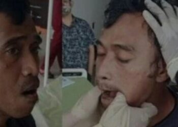 Viral Pria Tak Bisa Mingkem Gegara Tertawa dan Nguap Terlalu Lebar