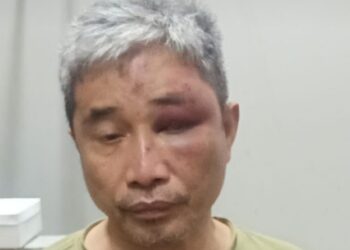 Lebam, Begini Tampang Muhammad Kece usai Dianiaya Irjen Napoleon