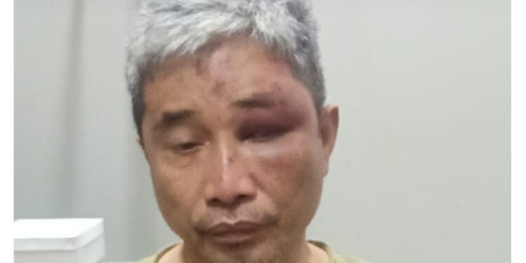 Lebam, Begini Tampang Muhammad Kece usai Dianiaya Irjen Napoleon