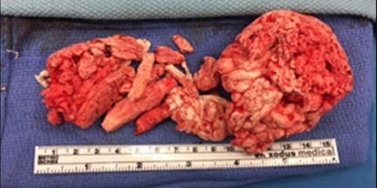 Parah! Istri Masukkan Busa Pengeras ke Penis Suami agar Ereksi, Ini Akibatnya
