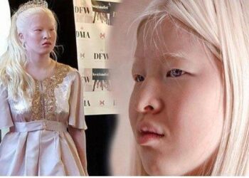 Nasib Gadis Albino Dibuang ke Panti Asuhan, Dewasanya Jadi Model Cantik Terkenal Dipakai Brand Dunia