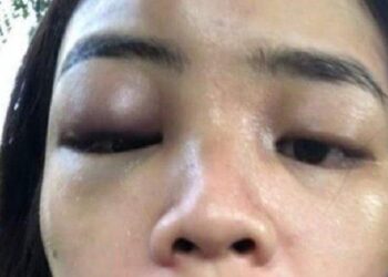 Heboh Seorang Wanita Jadi ‘Samsak’ Suaminya yang Jago Beladiri Selama 4 Tahun, Wajah Lebam