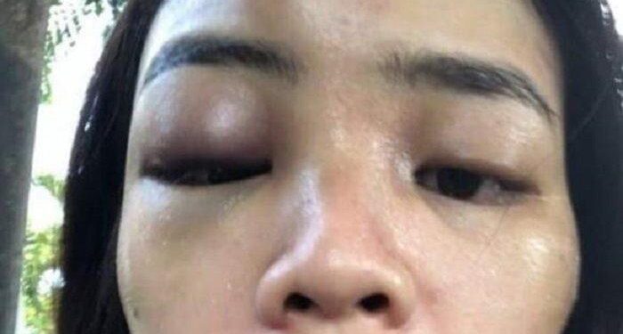 Heboh Seorang Wanita Jadi ‘Samsak’ Suaminya yang Jago Beladiri Selama 4 Tahun, Wajah Lebam