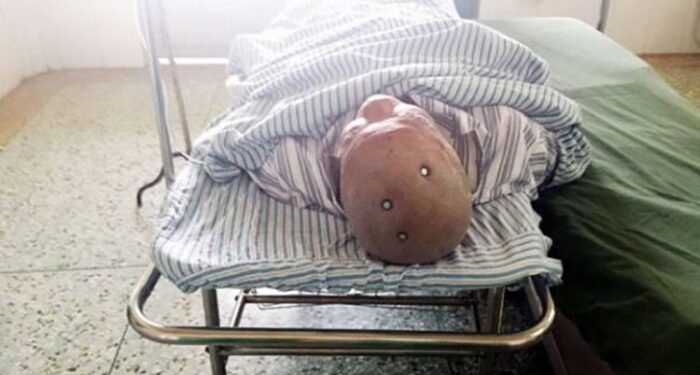 Dukun Yang Tancapkan Paku Di Kepala Agar Melahirkan Bayi Laki-Laki Diburu Polisi