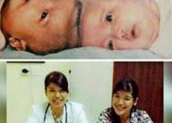 Kabar Yuliana & Yuliani Kembar Siam Pertama yang Berhasil Dioperasi di Indonesia, Sukses Jadi Dokter