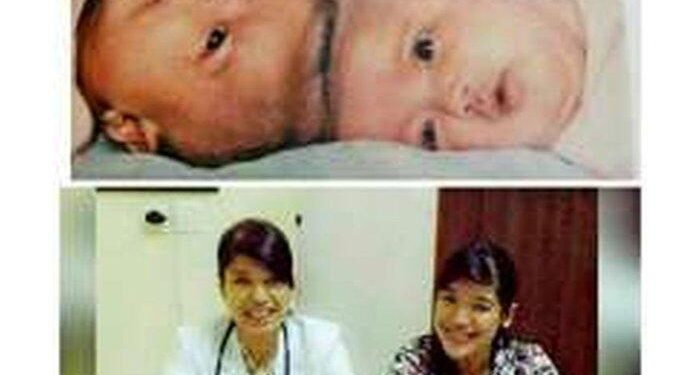 Kabar Yuliana & Yuliani Kembar Siam Pertama yang Berhasil Dioperasi di Indonesia, Sukses Jadi Dokter