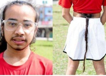 Namanya Deshant Adhikari, Manusia Berekor di Punggung, Sempat Merasa Malu Disebut Mirip Monyet
