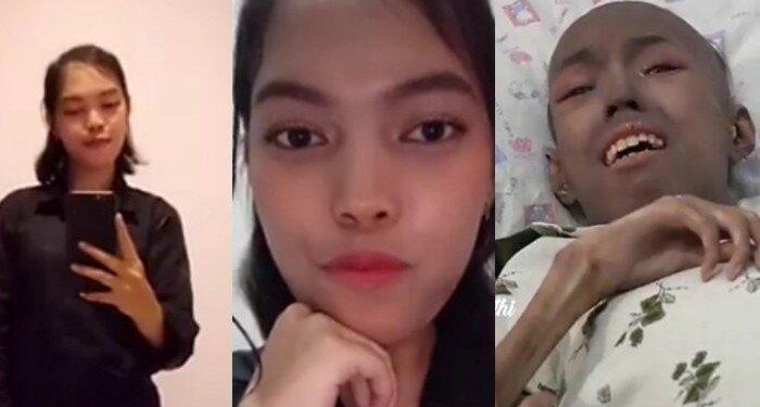 Nasib Pilu Gadis Berprestasi Mendadak Lumpuh Usai Raih Juara 1, Diduga Disantet Teman yang Cemburu