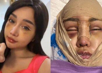 Mata Lucinta Luna tak Bisa Dibuka Pasca Operasi Gergaji Rahang & Tulang Ekor, Begini Kondisinya