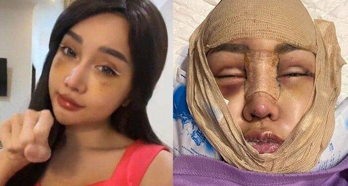 Mata Lucinta Luna tak Bisa Dibuka Pasca Operasi Gergaji Rahang & Tulang Ekor, Begini Kondisinya