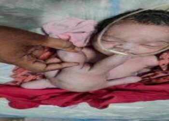 Bayi Ajaib di India, Punya Empat Kaki dan Empat Tangan, Warga Berbondong Datang Memuja