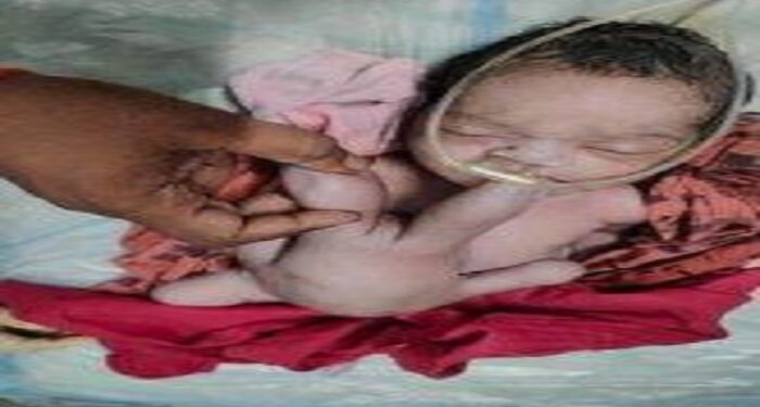 Bayi Ajaib di India, Punya Empat Kaki dan Empat Tangan, Warga Berbondong Datang Memuja