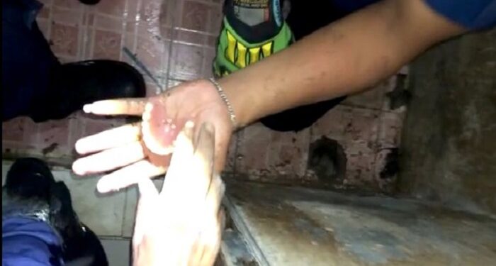 Dokter Saja Nyerah, Geger Damkar Lepas Cincin di Alat Vital