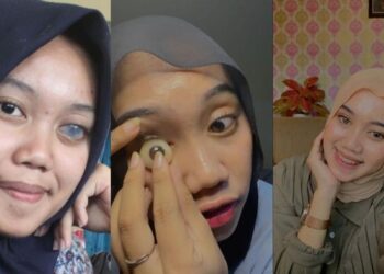 Viral Wanita Asal Yogya Mesti Ganti Mata Tiap 5 Tahun Sekali, Begini Kisahnya