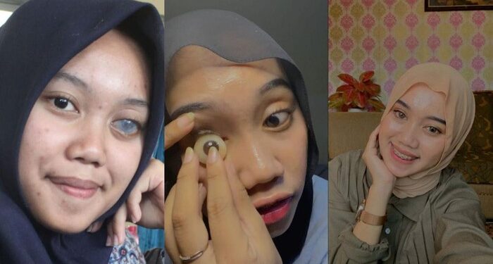 Viral Wanita Asal Yogya Mesti Ganti Mata Tiap 5 Tahun Sekali, Begini Kisahnya