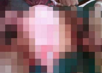 Kepala Bayi Putus Saat Persalinan di Puskesmas Indragiri Hilir