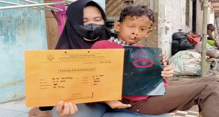 Tak Sengaja Telan Kunci, Bocah 8 Tahun Butuh Bantuan Biaya Operasi