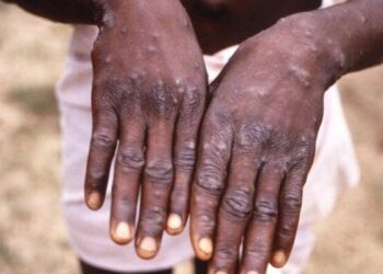 Dua Warga Tangerang Selatan Meninggal Terkonfirmasi Cacar Monyet