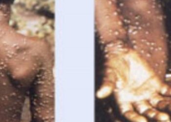 Virus Cacar Monyet Masuk Batam, Dinkes Kepri Yakinkan Penularan dari Sentuhan